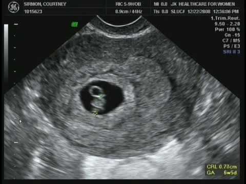 5 week miscarriage sac