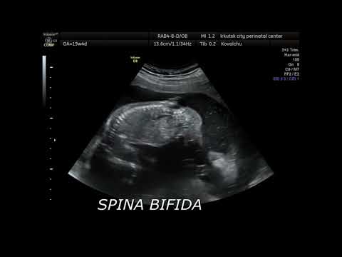 Spina bifida ultrasound 12 weeks