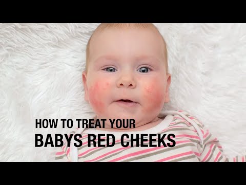 Red marks on baby cheeks