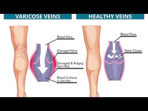 Left leg swelling in pregnancy