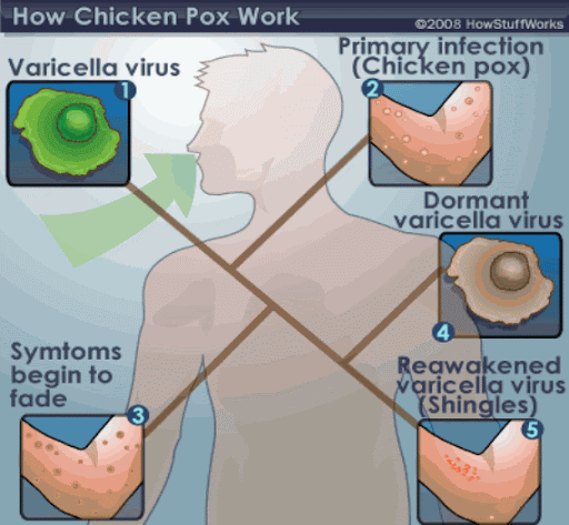How common is chicken pox