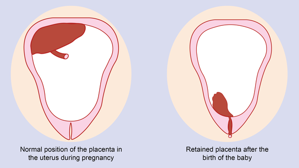 What cause a pregnant woman to bleed