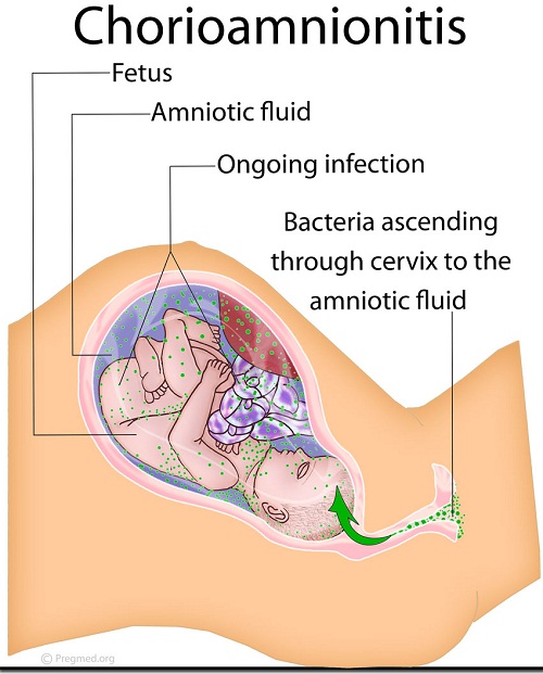 Fetal distress complications