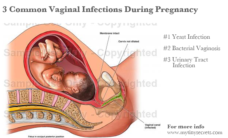 Yeast infection while pregnant discharge