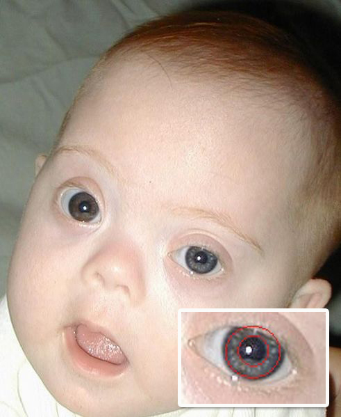 Red mark on newborn eyelid