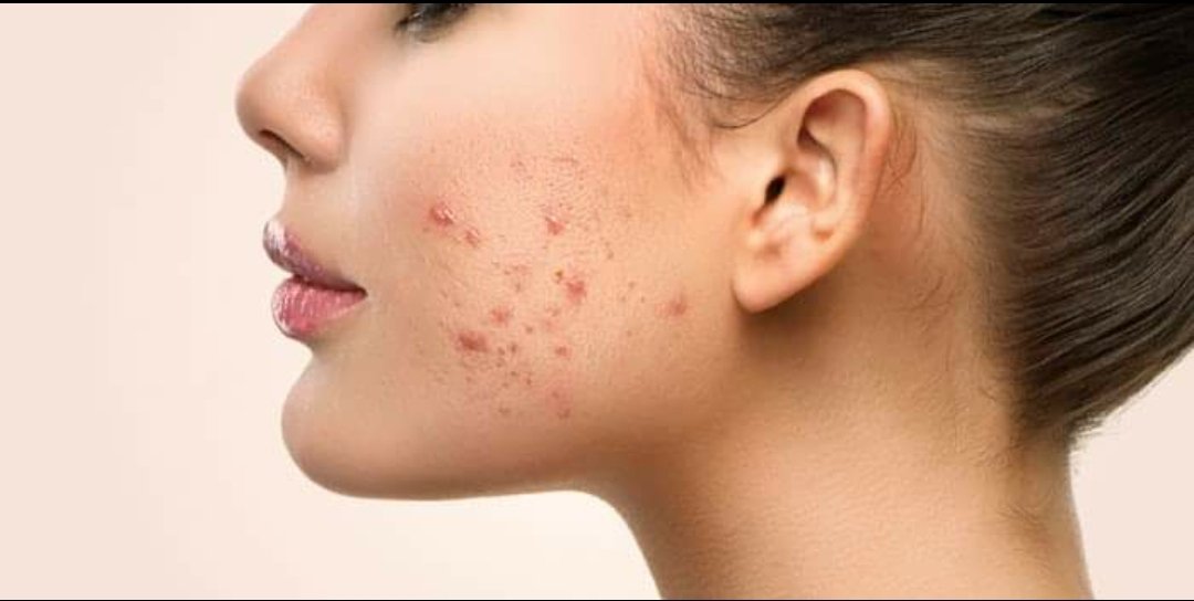 Rash like acne