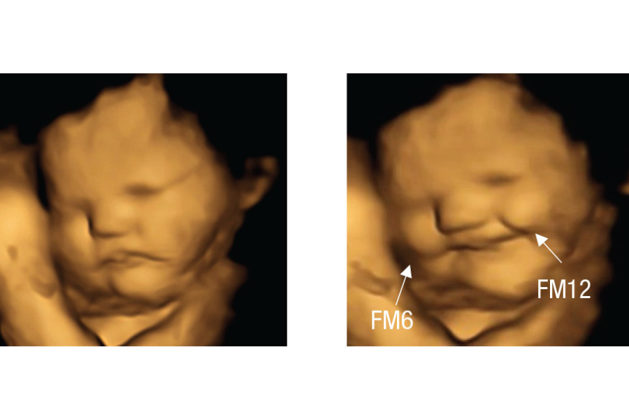 Radiation exposure to fetus