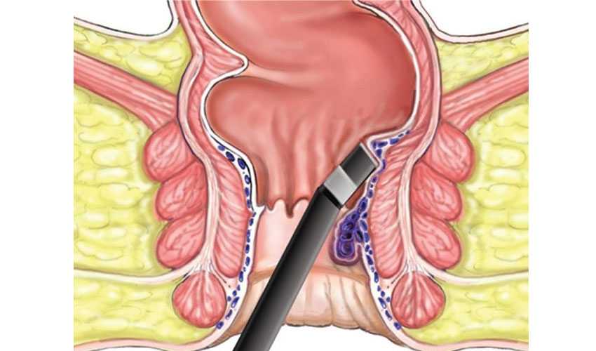 Hemorrhoids from birth