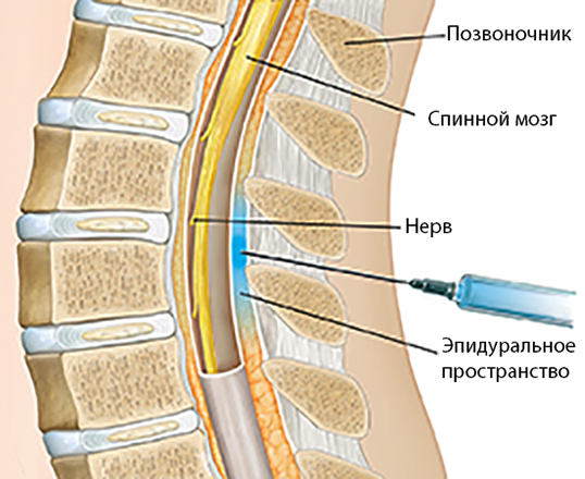 Эпидуральная спинная. Эпидуральное пространство спинного мозга. Эпидуральная блокада поясничного отдела позвоночника. Эпидуральная анестезия строение спинного мозга. Эпидуральная анестезия в грудном отделе позвоночника.