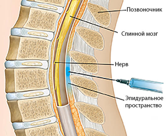 How long does an epidural last during labor