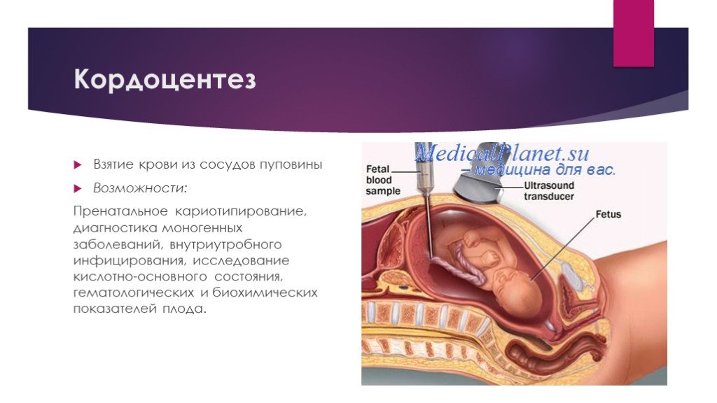 Miscarriage gush of fluid