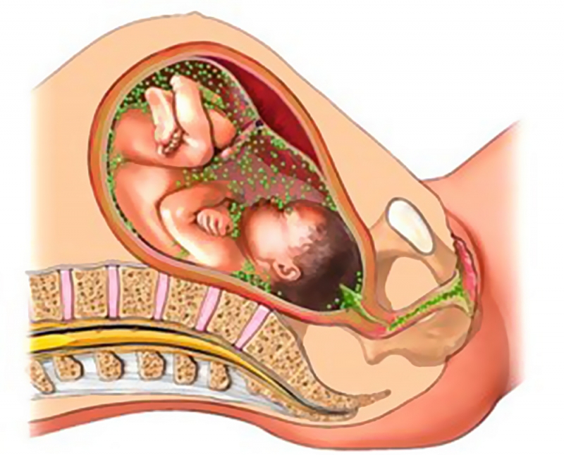 Treating chlamydia during pregnancy