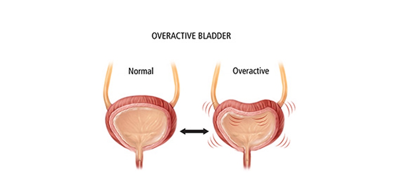 Urinary incontinence after c section