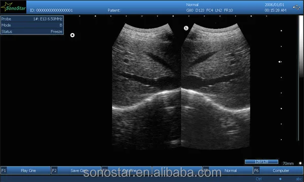 Trans vag ultrasound probe