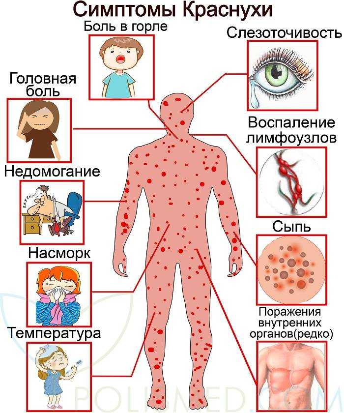 Symptoms for chickenpox in children