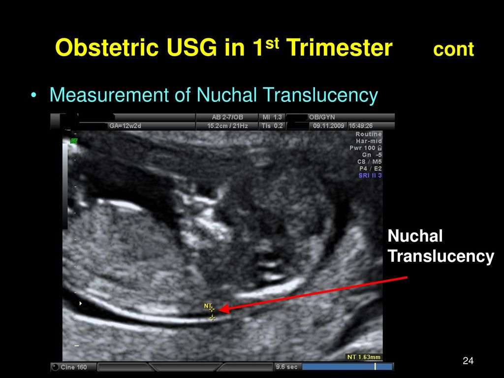 Nuchal translucency meaning