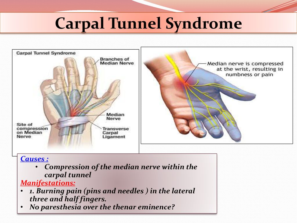 Excruciating carpal tunnel during pregnancy