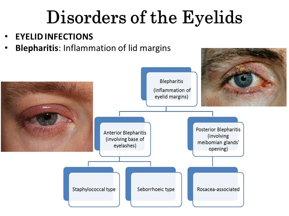 Infant eye infection treatment