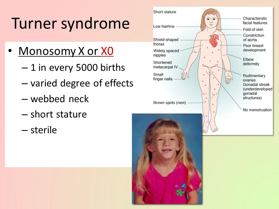 Mammary constriction syndrome