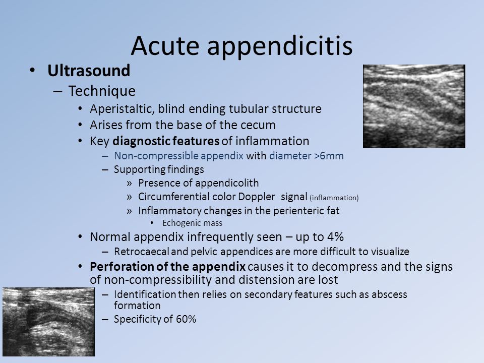 Breech presentation in ultrasound