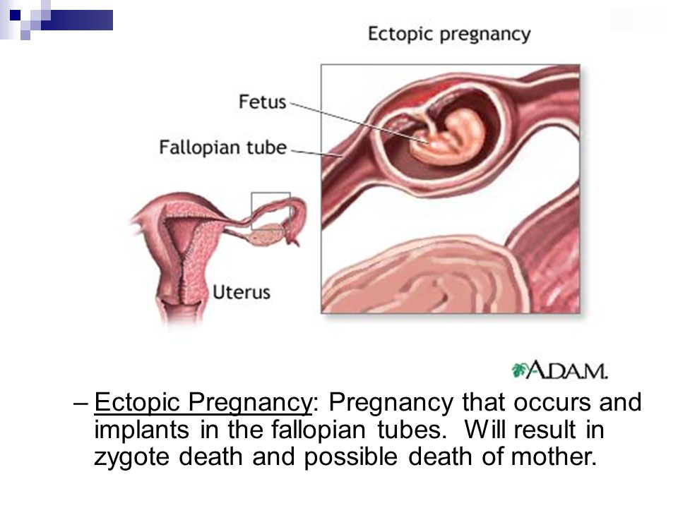 Bleeding during ectopic pregnancy