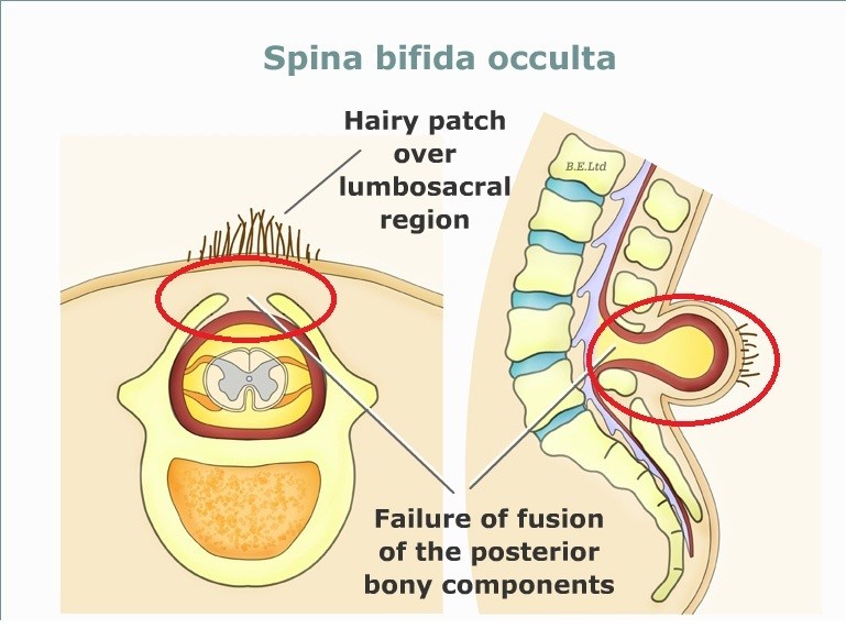 Anencephaly and spina bifida