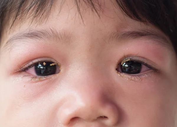 Red spot on baby eyelid