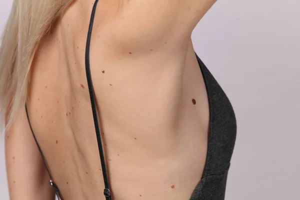Birthmark on chest
