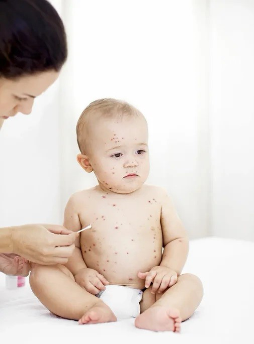 Chickenpox vaccine in pregnancy