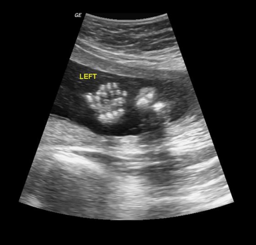 Amniocentesis for down syndrome