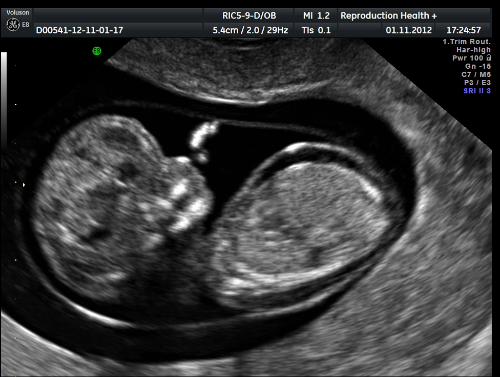 12 week ultrasound brain