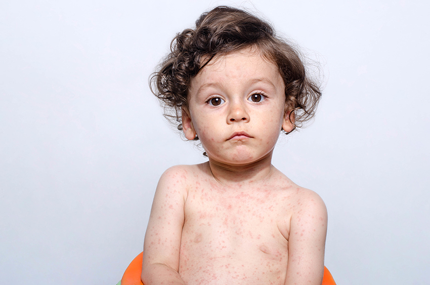 How to tell if your child has measles