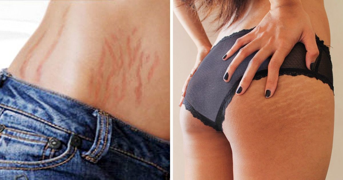 What does purple stretch marks mean