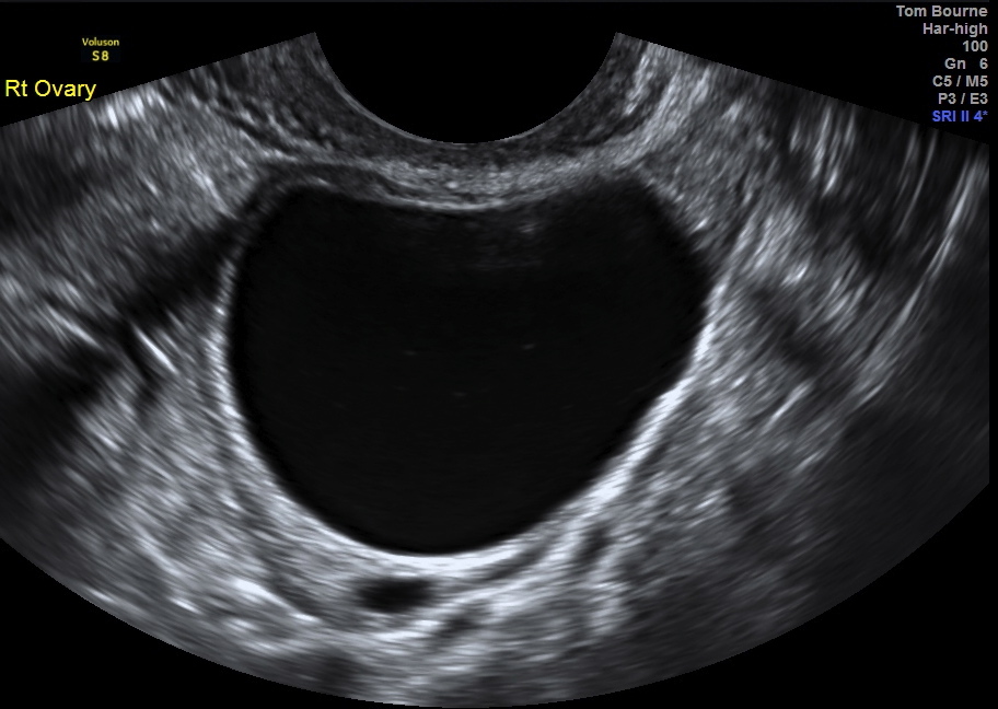 Internal vaginal ultrasound