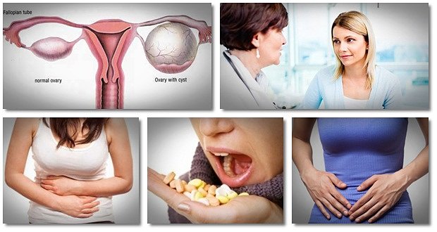 Can a woman with pcos get pregnant naturally