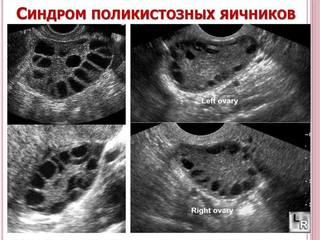 Pregnancy with polycystic ovary syndrome